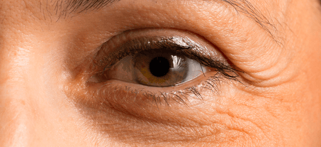 The Under-Eye Triad